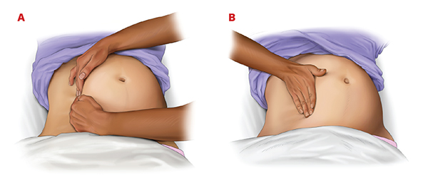 Figure 16. A, Manual left lateral uterine displacement, performed with 2-handed technique. B, 1-handed technique during resuscitation.
