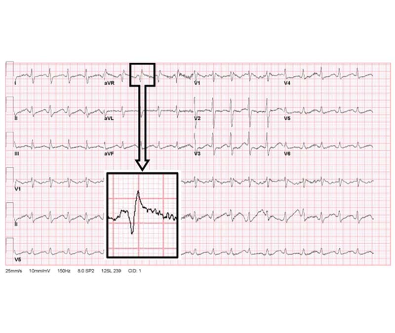 Figure 3. Typical Electrocardiographic Findings in a Patient With Sodium Channel Blocker Poisoning