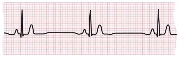 ECG strip showing bradycardia