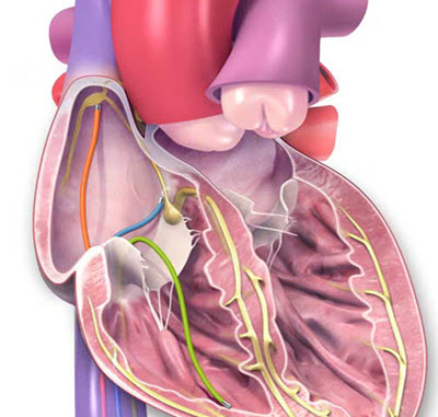 heart diagram showing leads for EP study