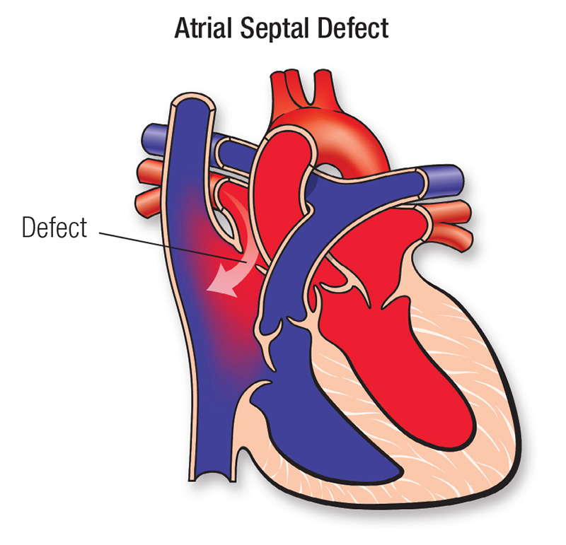 Atrial Septal Defect (ASD) American Heart Association CPR & First Aid