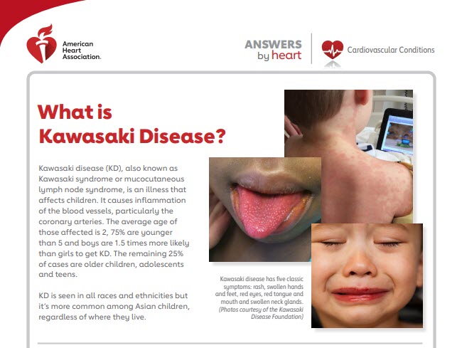 Kawasaki Disease: Complications and Treatment | American Heart ...
