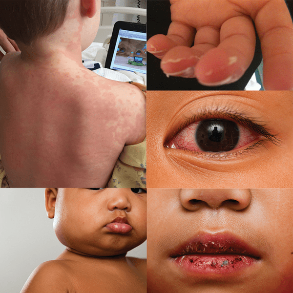 collage of symptoms of Kawasaki disease