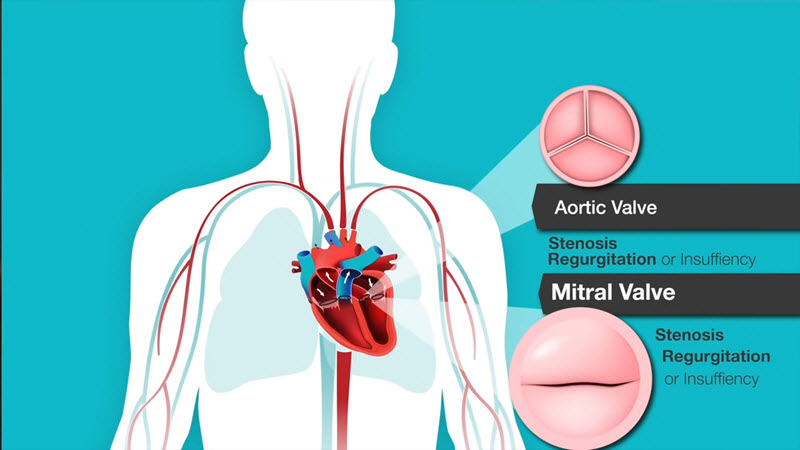 travel insurance innocent heart murmur