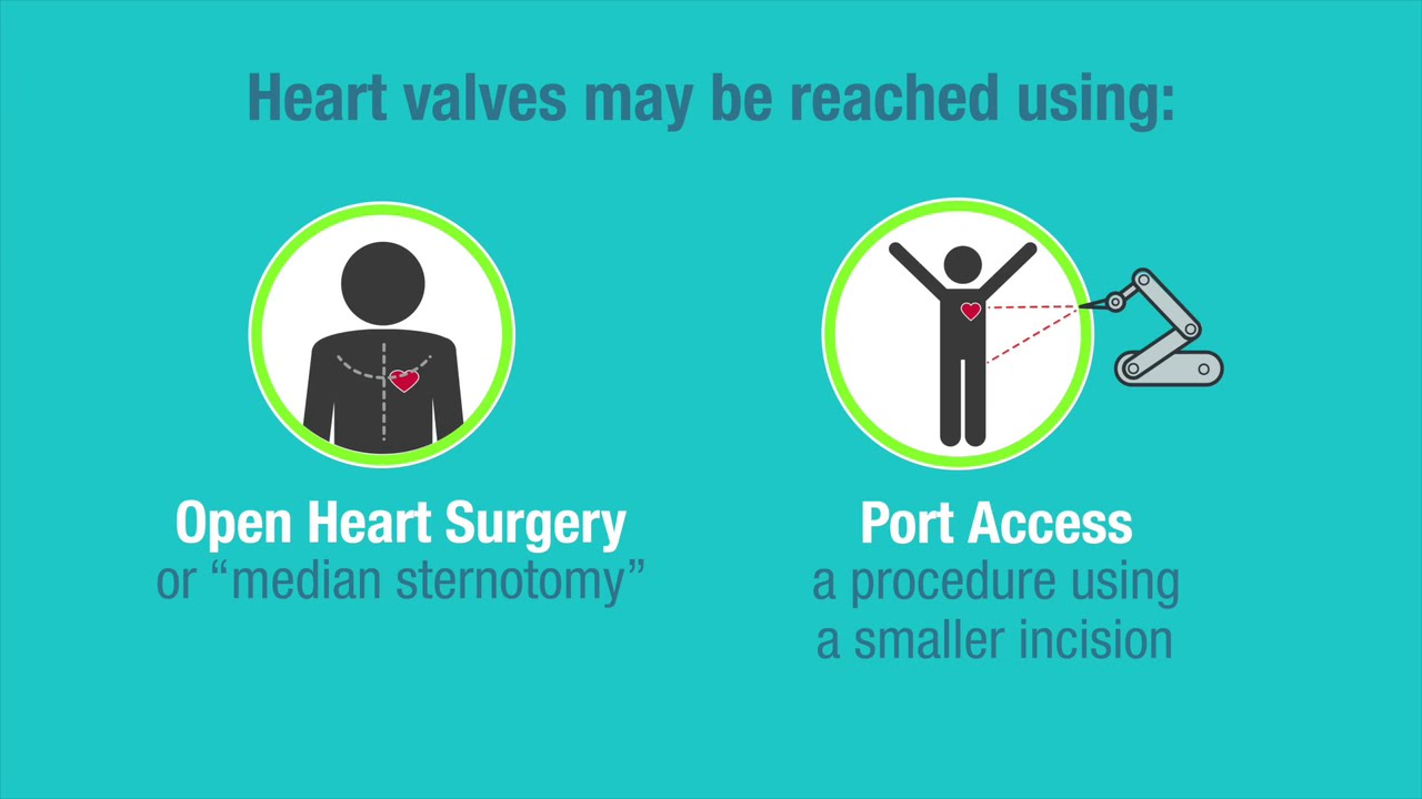 Types of Replacement Heart Valves American Heart Association CPR & First Aid