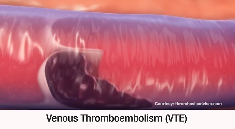 Venous thromboembolism video screenshot