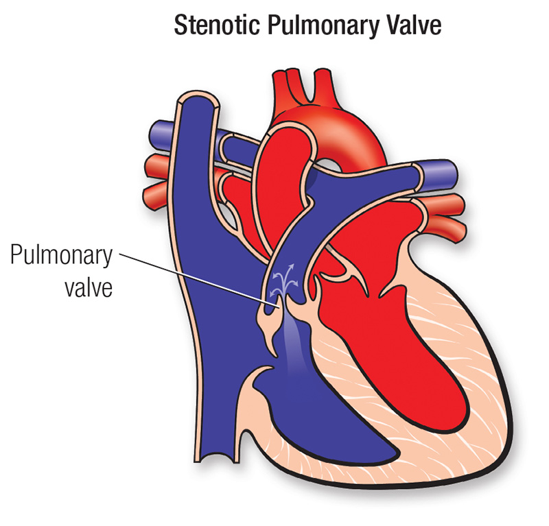 Pulmonary Valve Stenosis American Heart Association CPR & First Aid