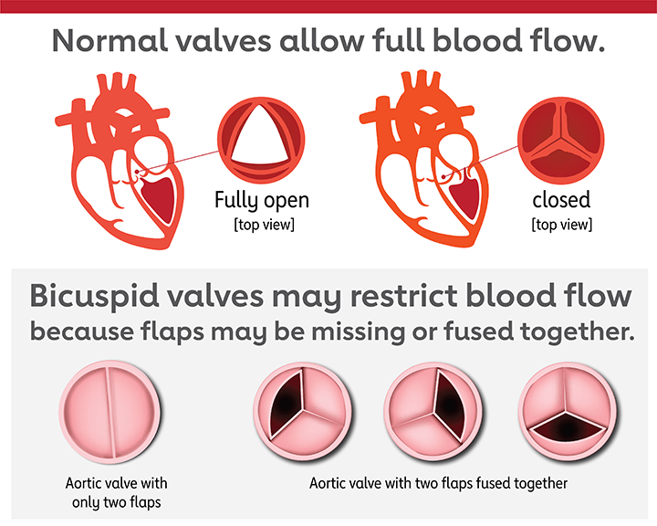 Problem: Heart Valve Stenosis | American Heart Association CPR & First Aid