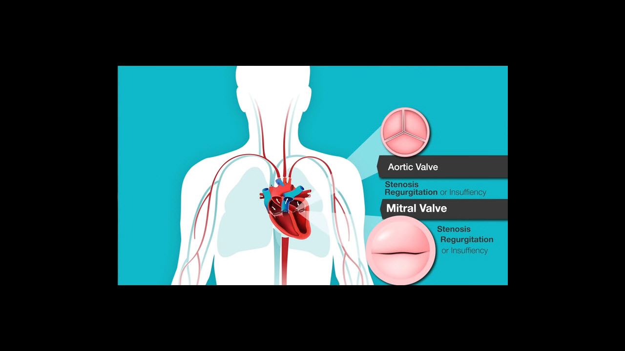 aortic-stenosis-overview-american-heart-association-cpr-first-aid