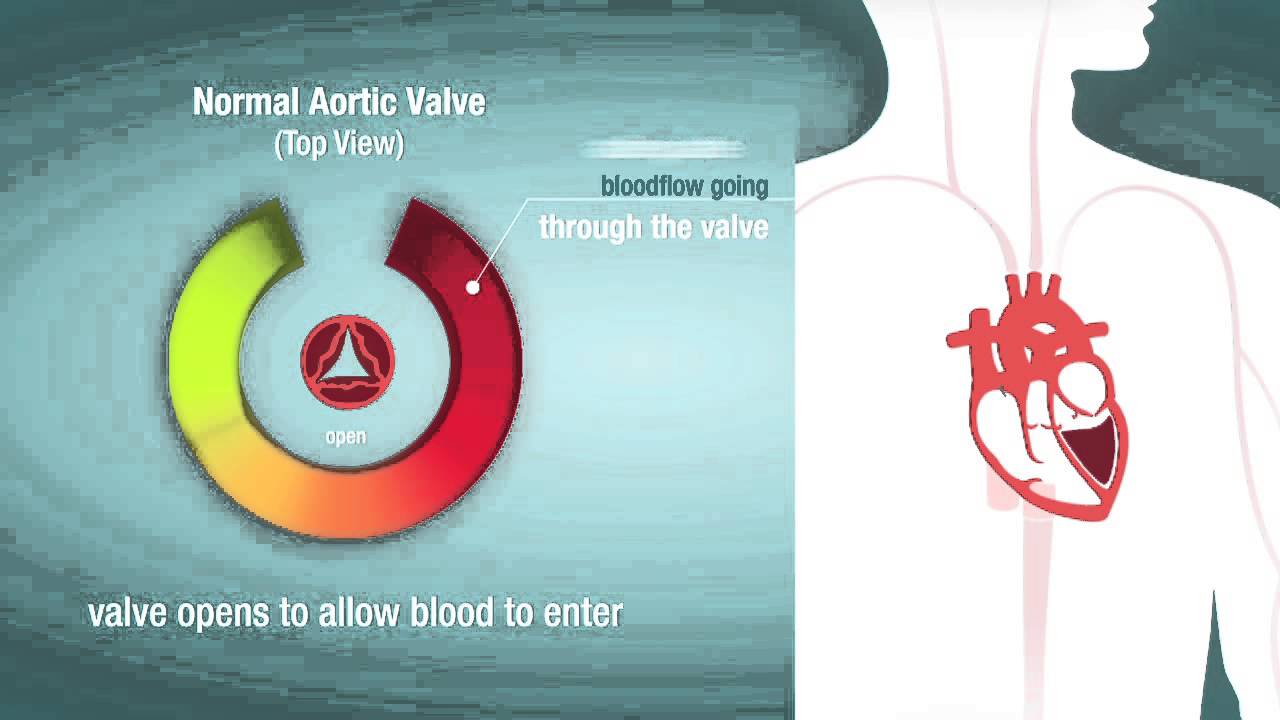 Problem Heart Valve Stenosis American Heart Association CPR & First Aid