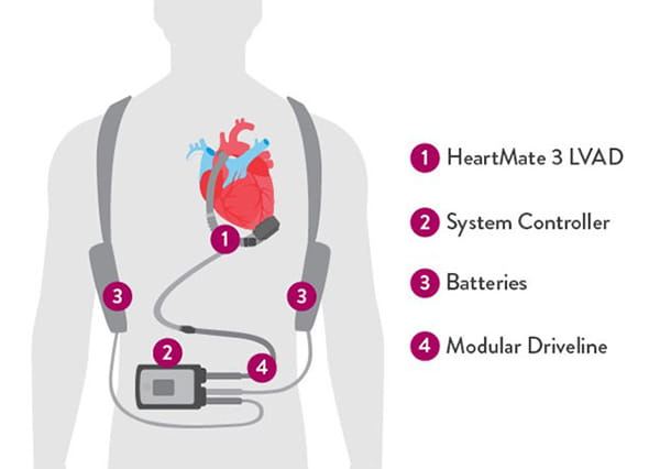 Figure 3 Components of the Abbott HeartMate 3 LVAD