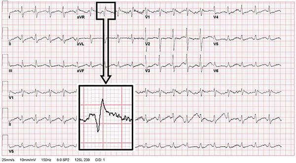 Figure 9 – Sodium channel blocker electrocardiogram