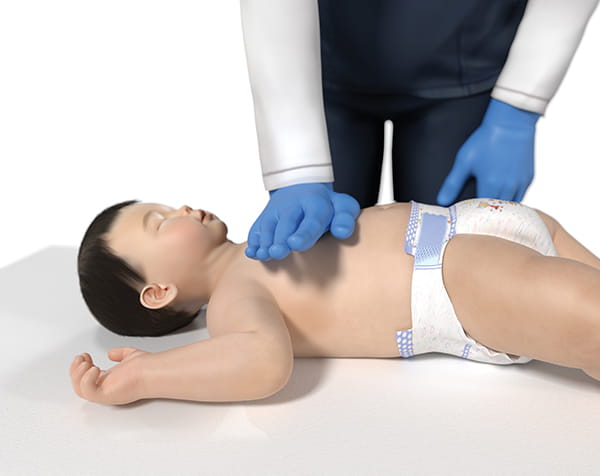 Figure 11 – 1-Hand technique for chest compressions in infants