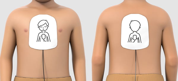 Figure 14 – Placement of pediatric pads_anteroposterior position