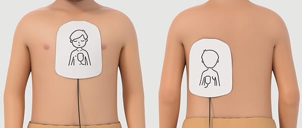 Figure 15-Placement pedipads alternative anteroposterior position