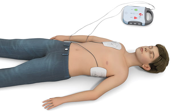 Figure 16 – Placement of pediatric pads in the anterolateral position