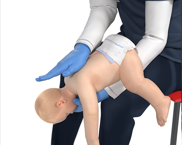 Figure 4 – Back blows in infant