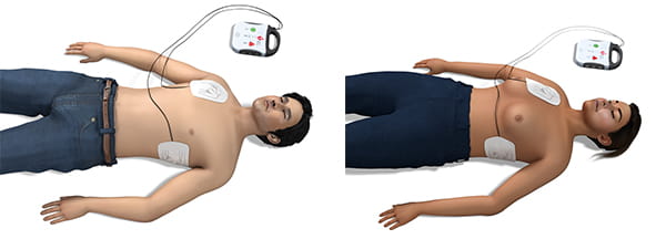 Figure 7. Electrode pad placement for defibrillation