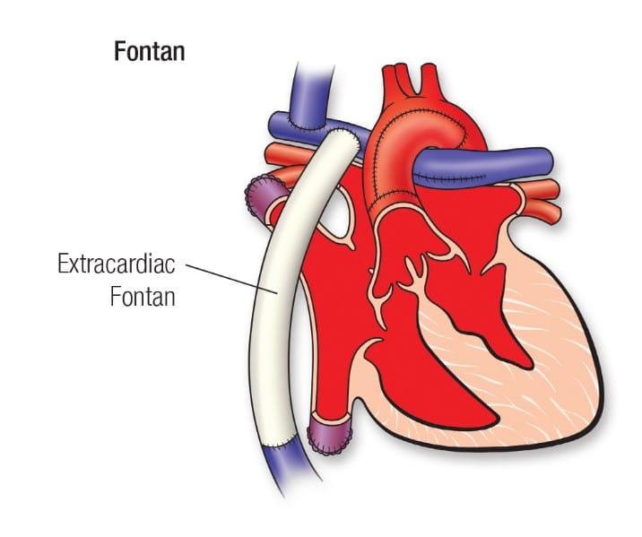 Figure 10 – Stage III Fontan single ventricle palliation