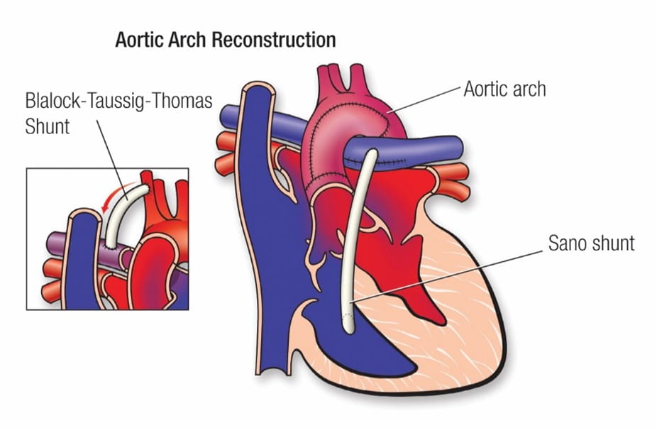 Figure 8 – Stage I palliation for single ventricle