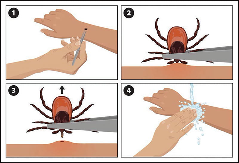 Figure 5. Tick removal. Reproduced from Centers for Disease Control and Prevention. Ticks image gallery.